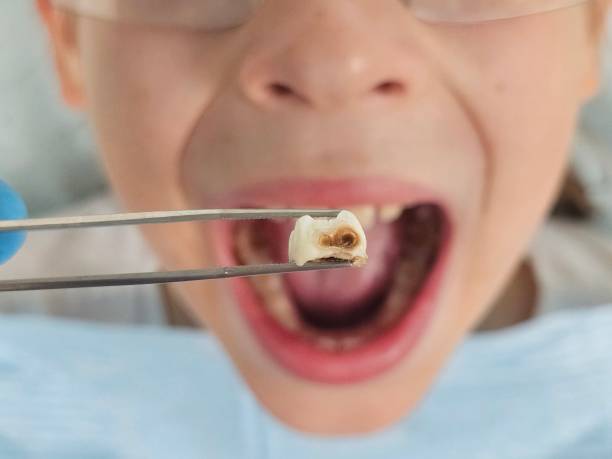 Best Emergency Treatment for Dental Infections or Abscesses in Tanaina, AK